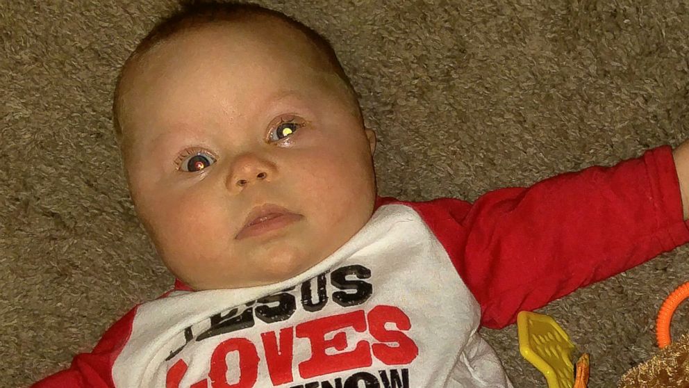 PHOTO: Scottsdale, Arizona, mother Andrea Temarantz said camera flashes that produced a "glow" in the eye of their baby son, Ryder, helped detect his retinoblastoma, which was diagnosed on Jan. 5, 2016