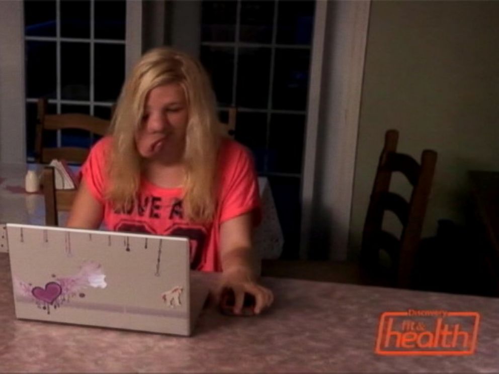 PHOTO: Sarah Atwell, 17, has a rare disease called neurofibromatosis, causing a massive tumor to develop on half her face.