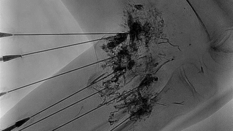 PHOTO: An MRI image showing the needles and glue injection. Doctors used an experimental treatment with "medical superglue" to remove the mass.