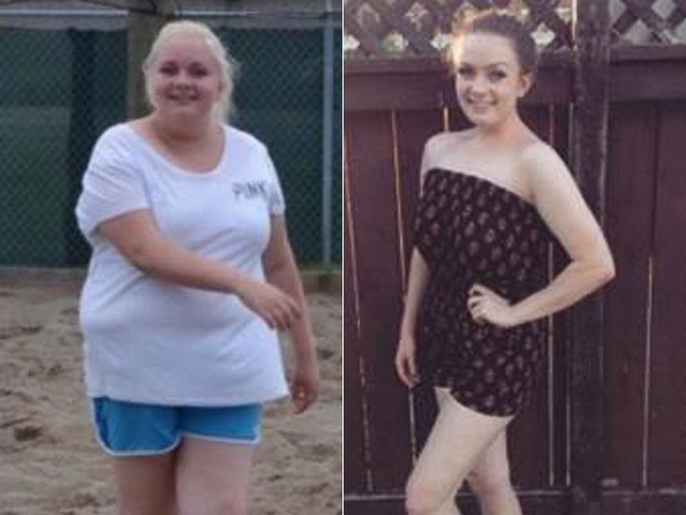 PHOTO: MacKenzie Walker, 16, of Windsor, Ontario, lost more than 100 pounds. 