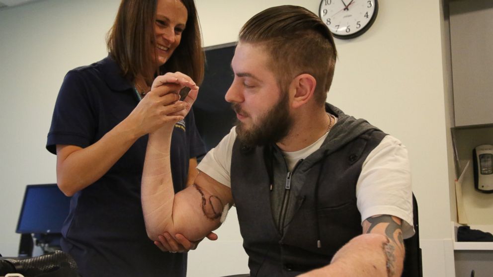 Retired Marine Who Underwent Double Arm Transplant Wiggles Fingers ...