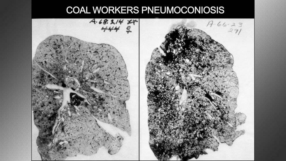 This occupational health image shows the lungs of a coal worker with Pneumoconiosis, or Black Lung Disease.
