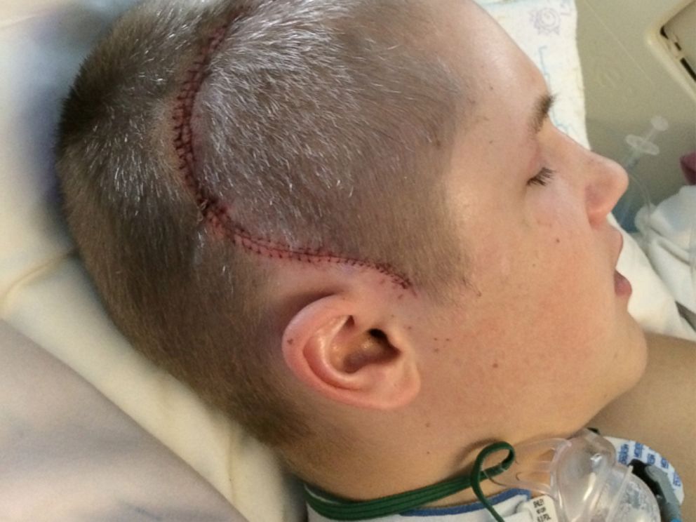 PHOTO: Blake Hyland had hit his head on concrete trying a new gymnastics trick, prompting doctors to remove his skull while his brain swelled.