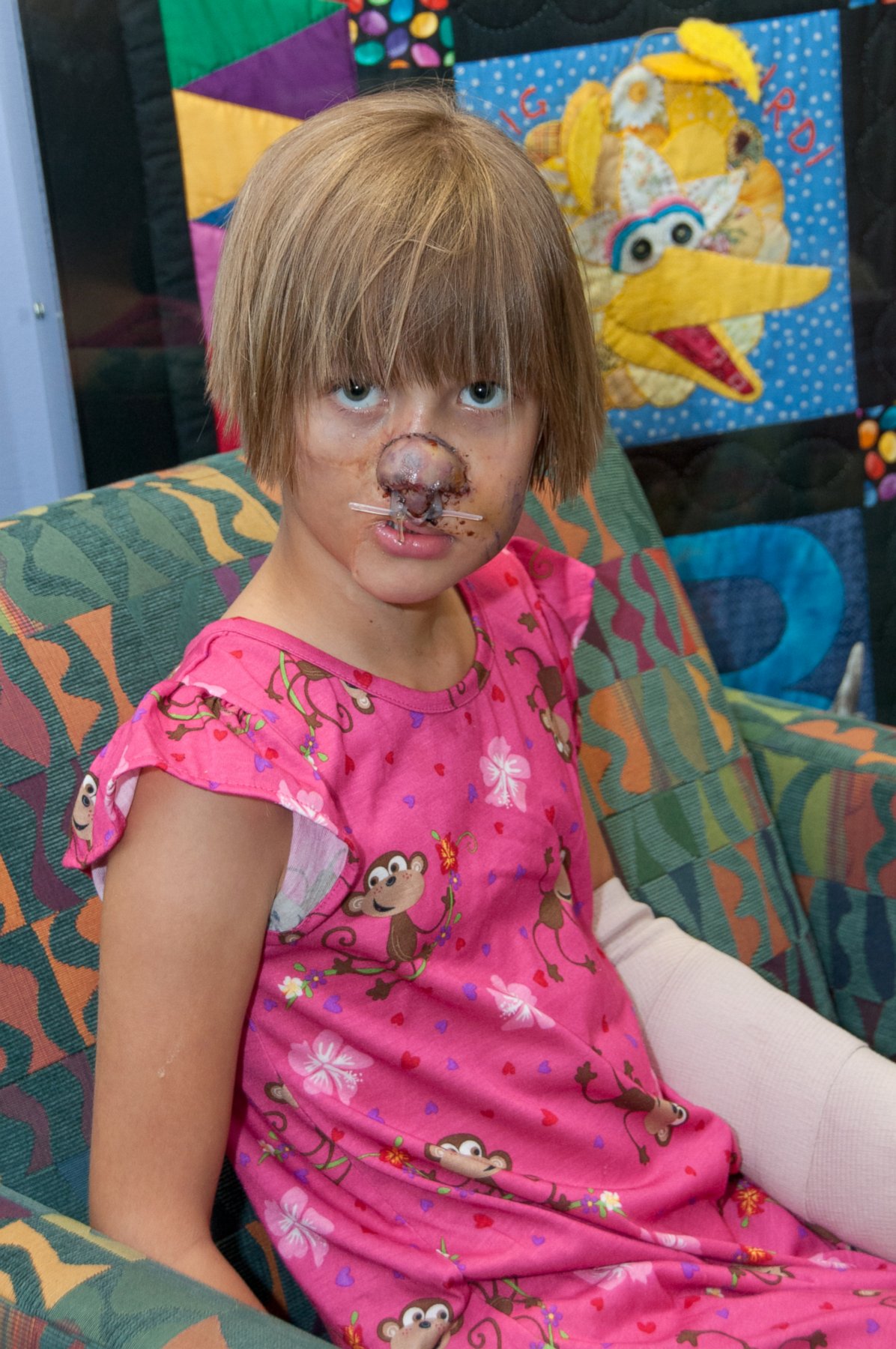 PHOTO: Charlotte Ponce, then 9, after plastic surgeons rebuilt her nose at Beaumont Children’s Hospital in Michigan.