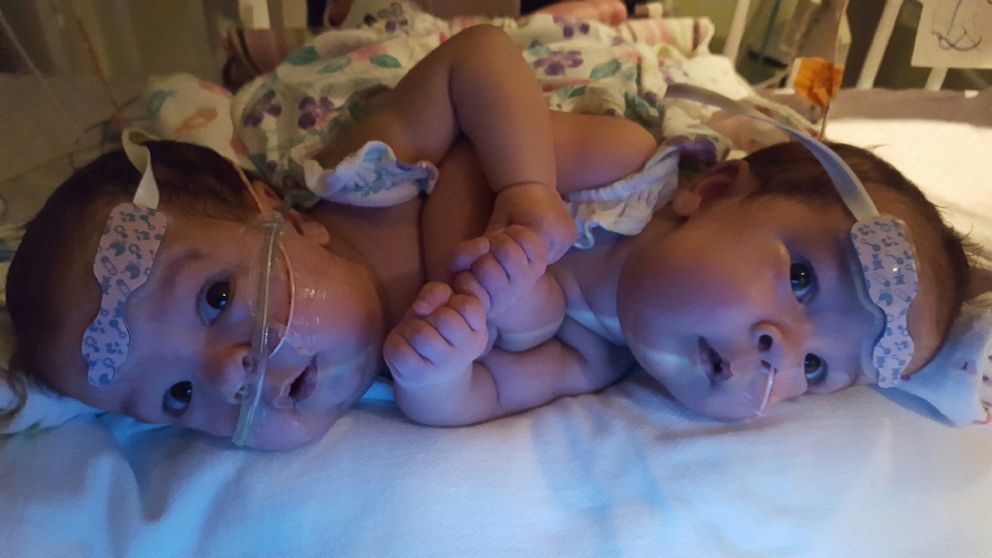 Florida Doctors Separate Conjoined Twins Connected At Heart With Help