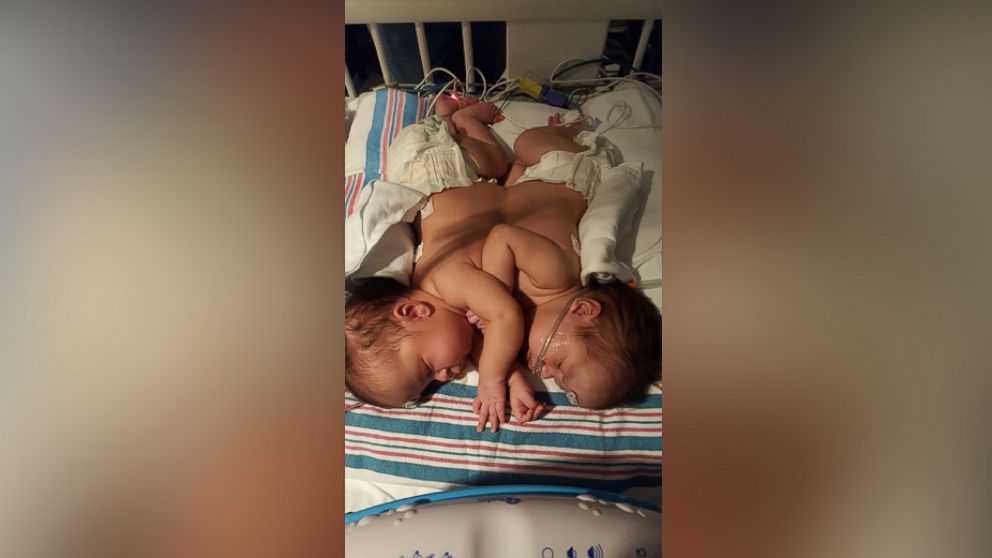 PHOTO: Doctors at the University of Florida Shands Children's Hospital in Gainesville, Florida, separated conjoined twins connected at the heart and liver, in June 2016. 