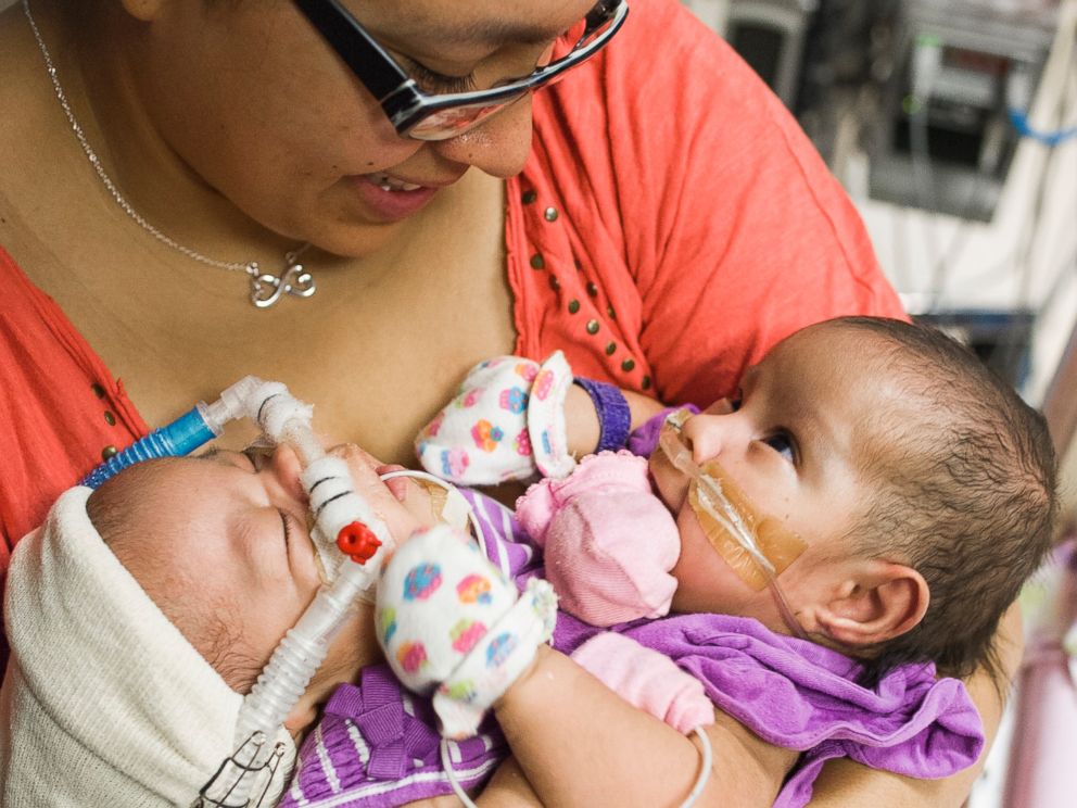 Texas Conjoined Twins Await Surgery To Lead Separate Lives Abc News 7159