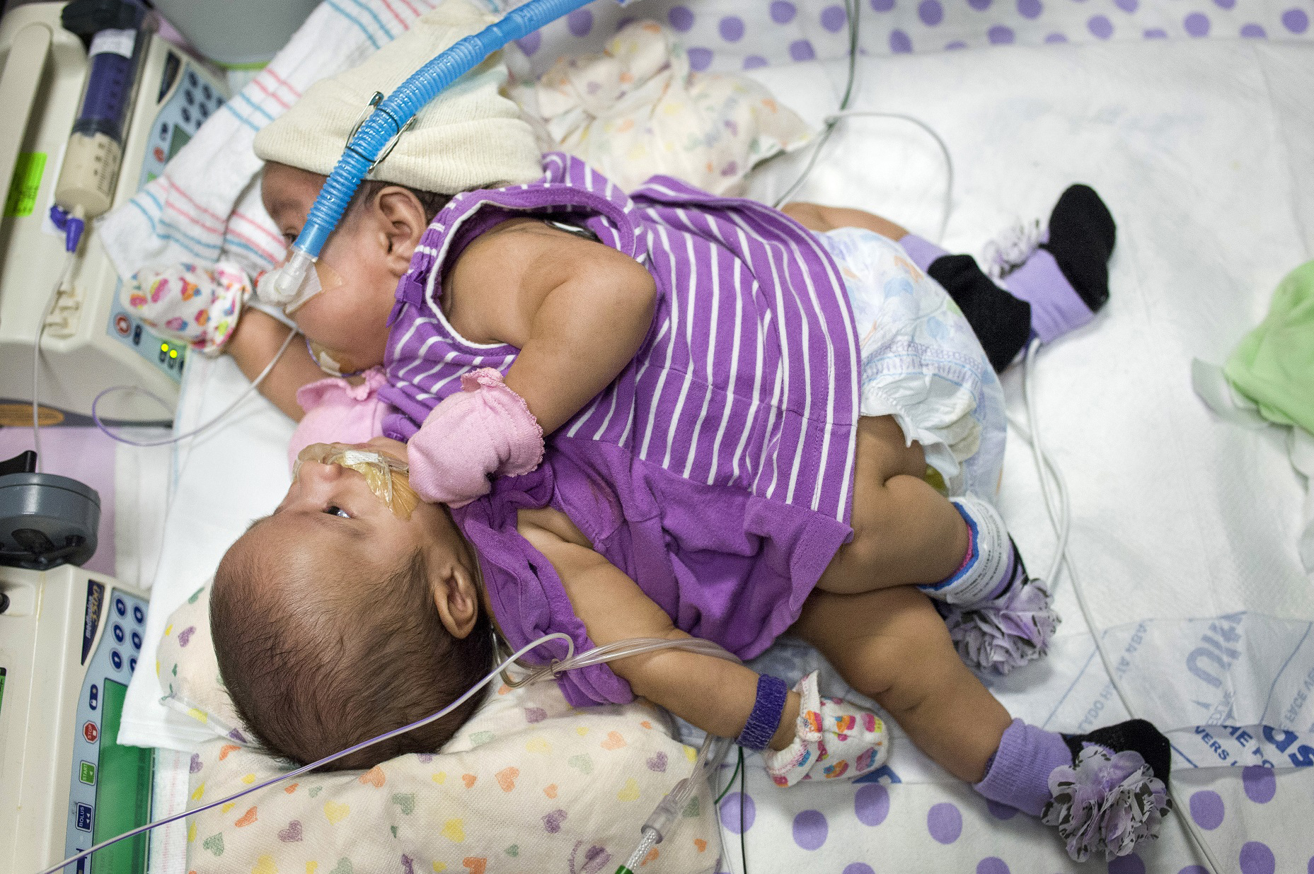 PHOTO: Elysse Mata gave birth to conjoined twins at Texas Children's Hospital in Houston, April 11, 2014.