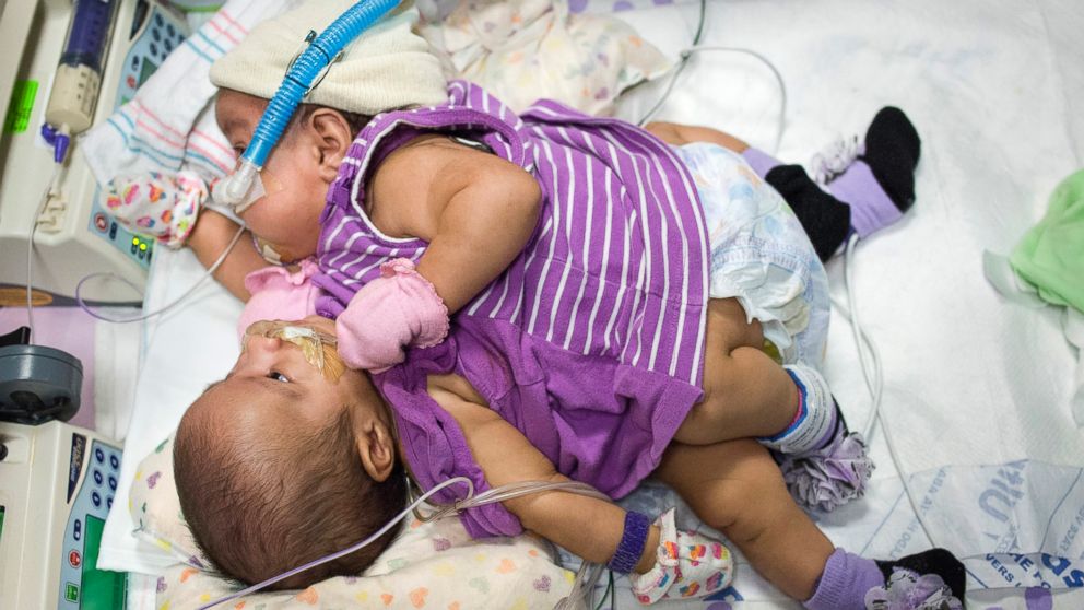 PHOTO: Elysse Mata gave birth to conjoined twins at Texas Children’s Hospital in Houston, April 11, 2014.