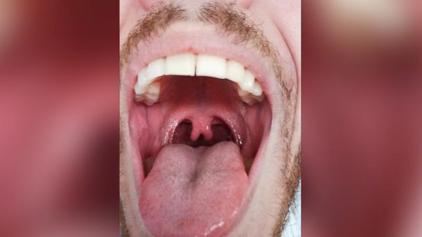 Photo of Man's 'Double' Uvula Goes Viral - ABC News