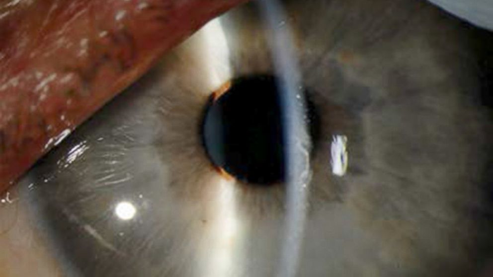 PHOTO: Ebola lingers in recovered patient’s eye.