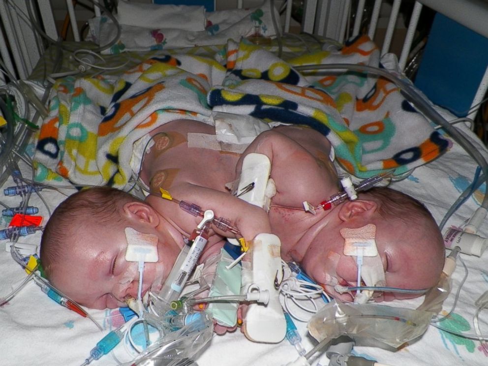 PHOTO: Conjoined twins, Emmit and Owen Ezell before separation surgery.