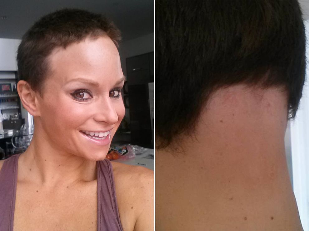 Hair Model Stricken With Alopecia