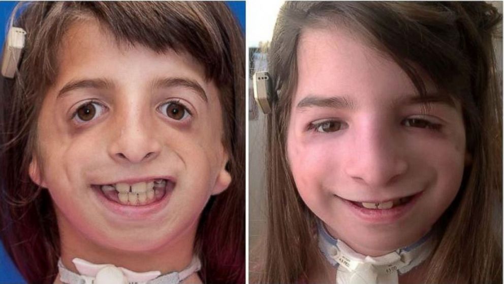 Hannah Schow was born with a genetic condition that left her airway deformed.