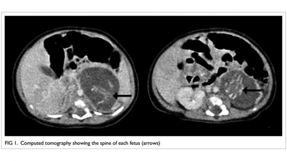 PHOTO: A baby was born with possible absorbed twin inside her.