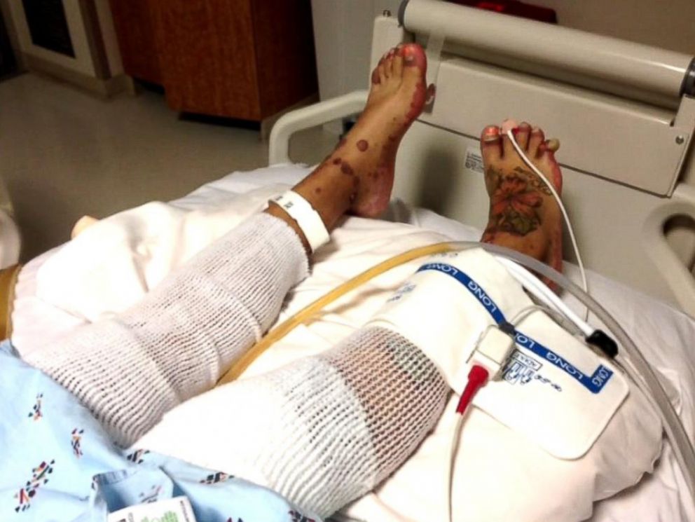 PHOTO: Yaasmeen Castanada is in intensive care after having a severe allergic reaction to a mediation that caused her body to burn from the inside out.