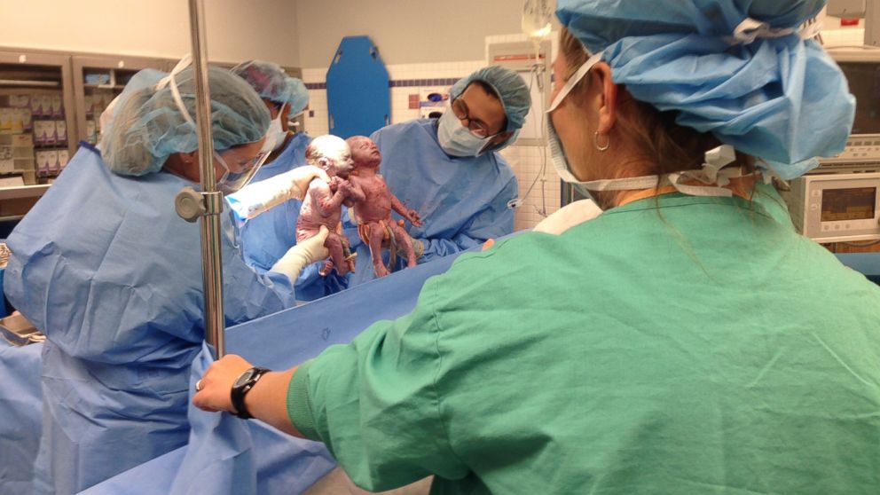 PHOTO: A pair of "mono mono" twins held hands after being born. 
