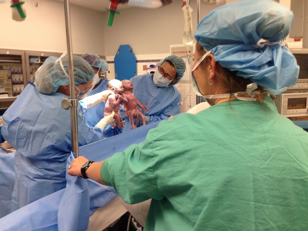 PHOTO: A pair of "mono mono" twins held hands after being born. 