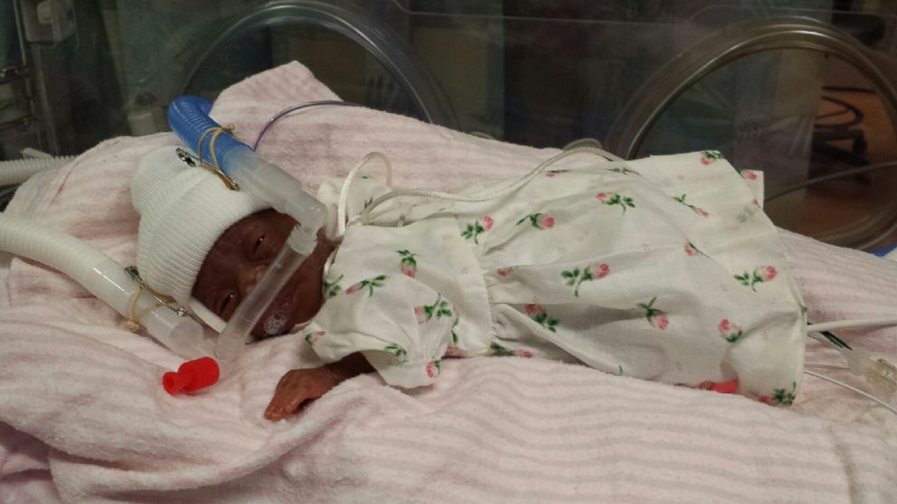PHOTO: E'layah Faith, born nearly 14 weeks premature on Sept. 23, 2015, at 10 ounces and 10 inches long, is the smallest surviving baby born at Carolinas Medical Center in Charlotte, N.C. 