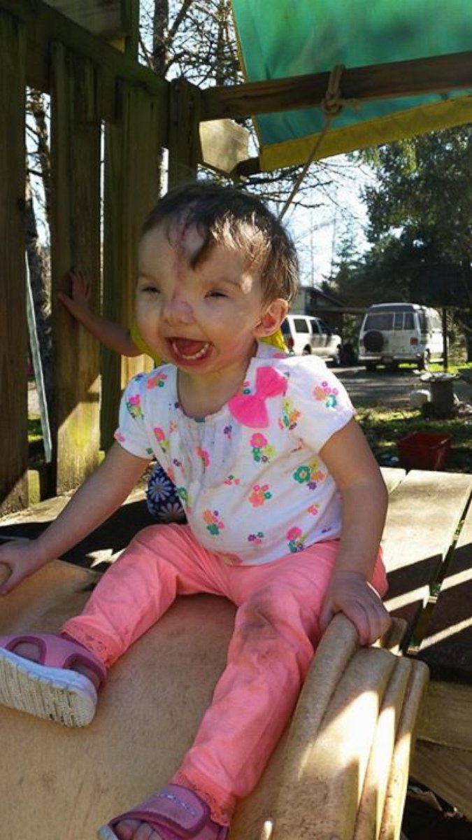 PHOTO: A toddler is happy and recovering months after her face was rebuilt with the help of a 3-D printer.