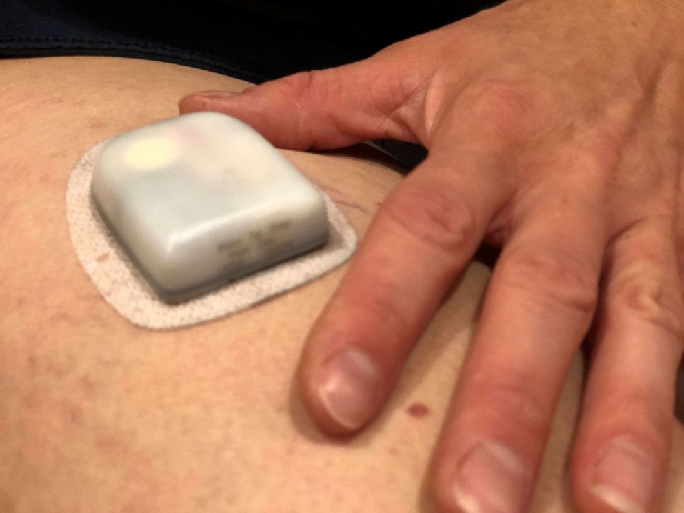 PHOTO: An insulin pump regulates a patient's blood sugar levels. 