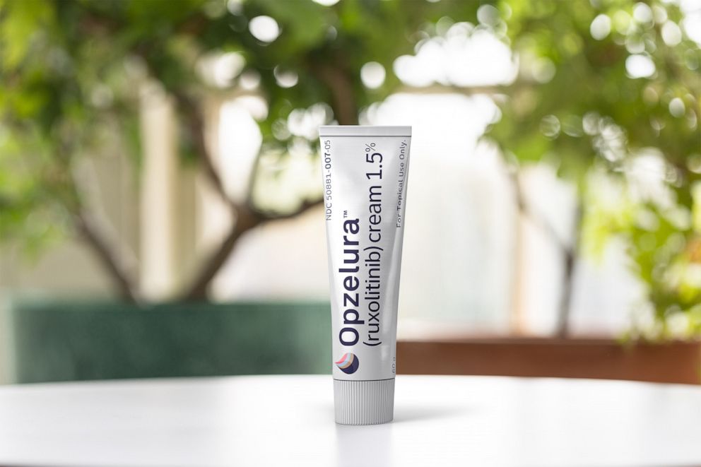 Foto: Opzelura es la primera crema aprobada para tratar enfermedades autoinmunes que decoloran la piel.