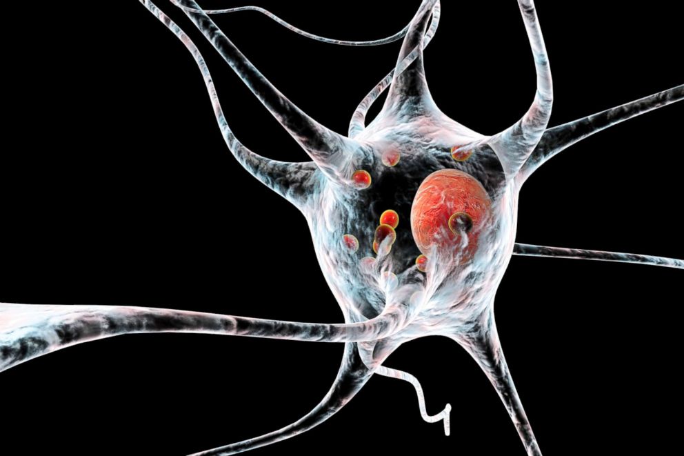 PHOTO: A Computer illustration of Parkinsons disease nerve cells. 