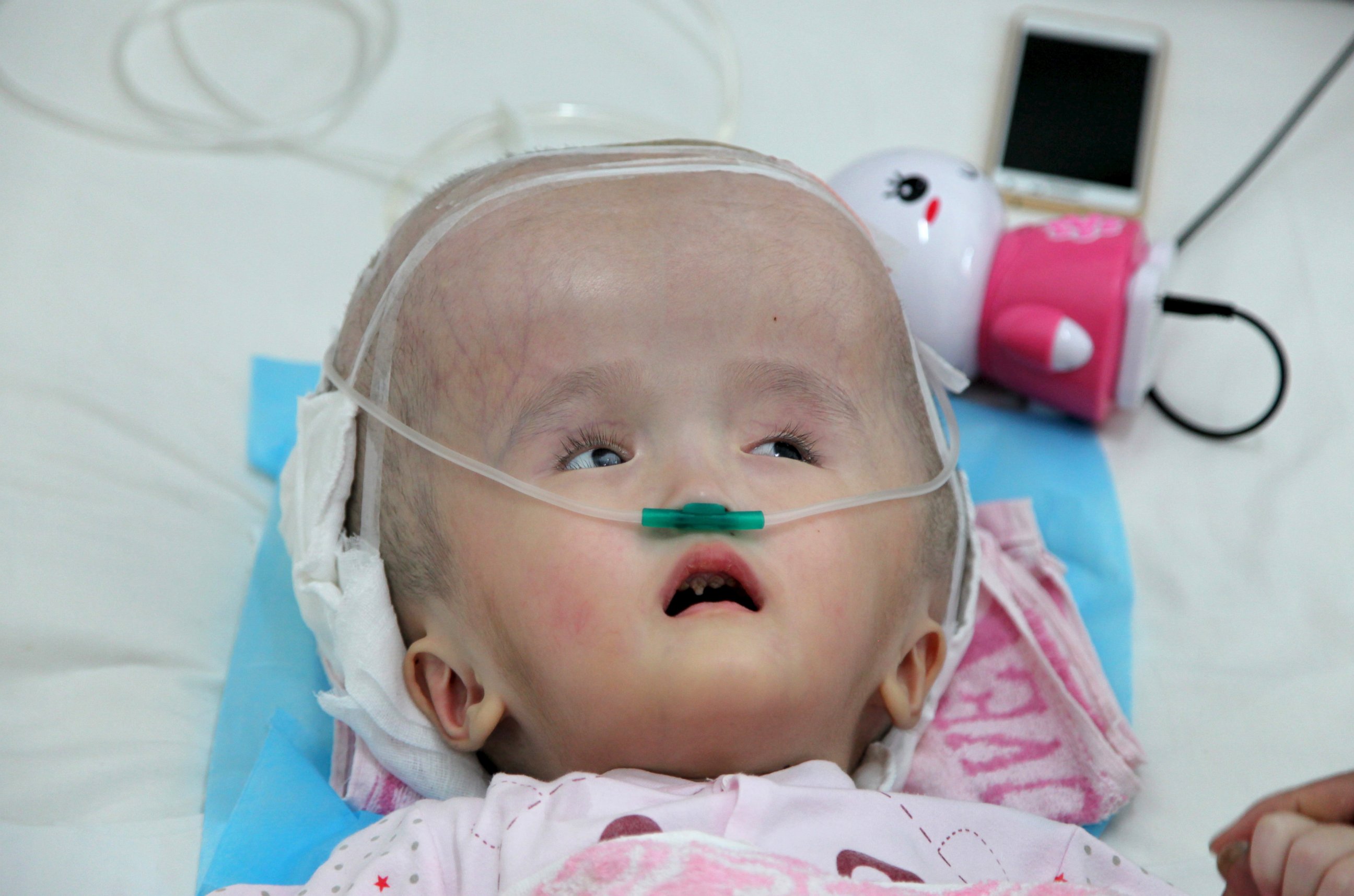 PHOTO: Three-year-old Hanhan is seen before a surgery to implant three pieces of titanium mesh to replace her skull, at a hospital in Changsha, Hunan province, China, July 14, 2015. 