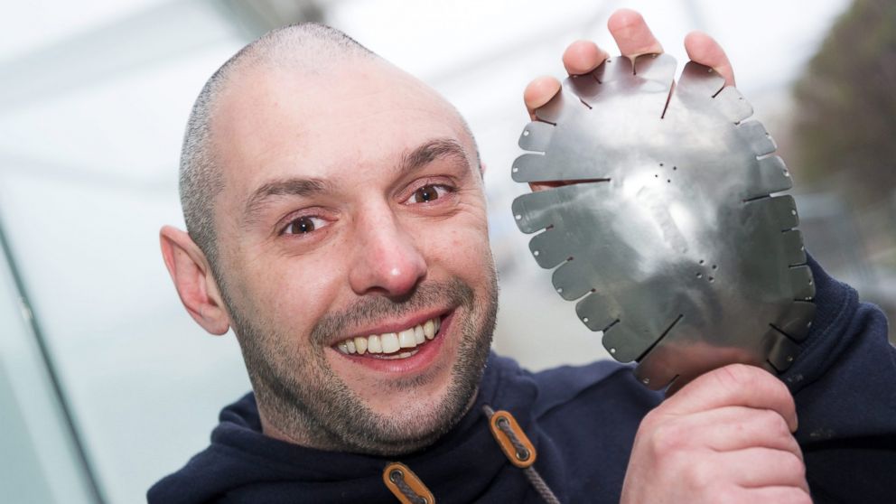 Lee Charie holding a metal plate before it was placed into his head in March 2014. 