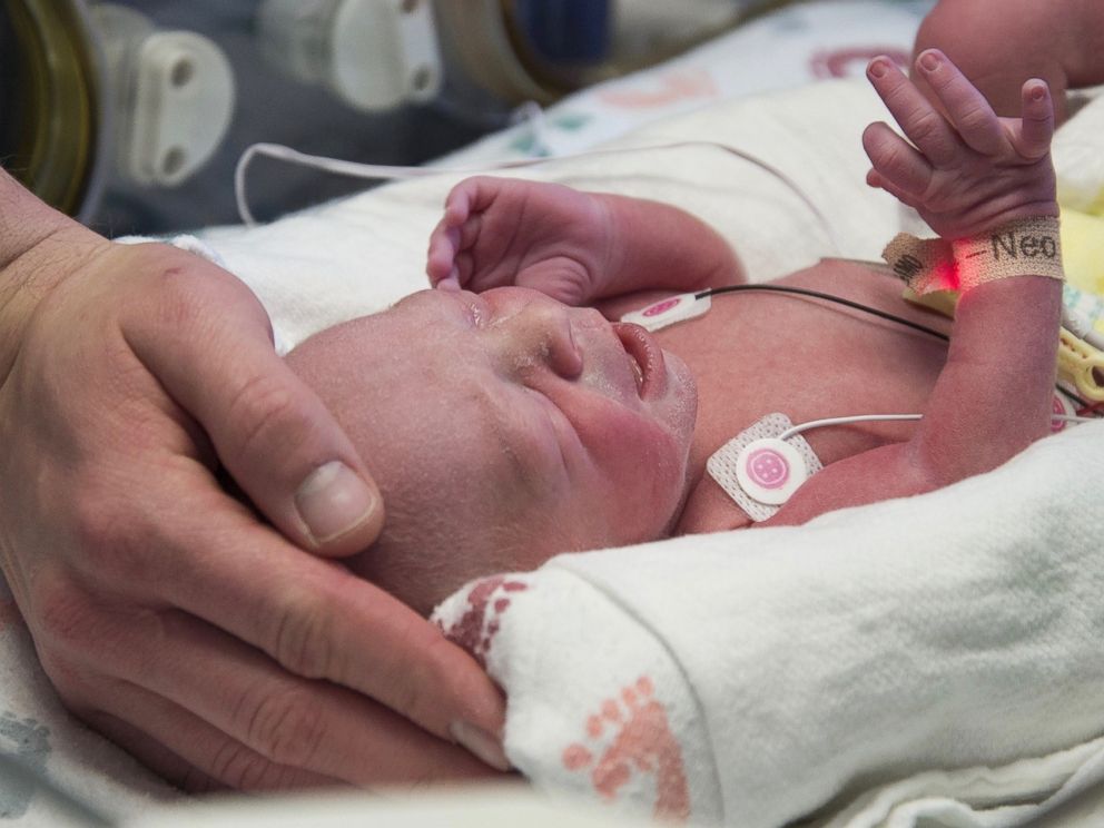 PHOTO: The first American baby born from a transplanted uterus is photographed here after being born at the Baylor University Medical Center in Dallas, Texas. 