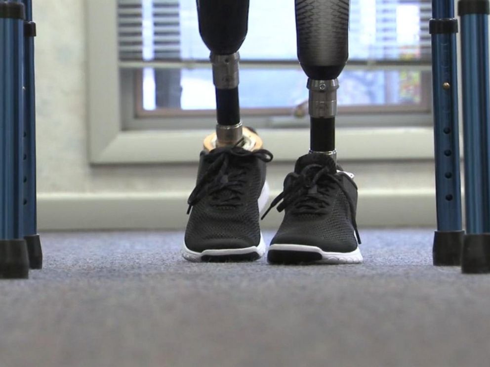 PHOTO: Vidal Lopez, 19, lost both his legs above the knee after a car accident in Mexico in the summer of 2016. On Feb. 6, 2017, he was able to walk again with the help of two microprocessor controlled knees donated by the foundation of Heather Abbott.