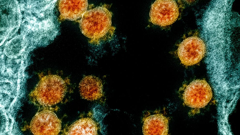 This electron microscope image made available and color-enhanced by the National Institute of Allergy and Infectious Diseases Integrated Research Facility in Fort Detrick, Md., shows Novel Coronavirus SARS-CoV-2 virus particles, orange, isolated from