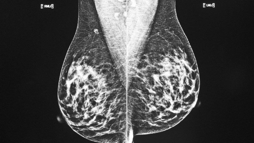 Plus de patientes atteintes d’un cancer du sein peuvent choisir une chirurgie plus petite