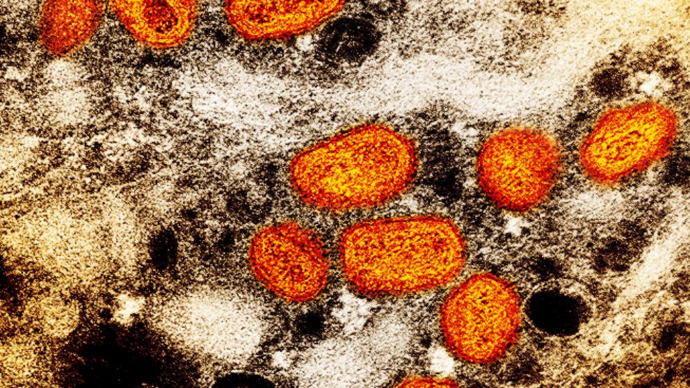 This iamge provided by the National Institute of Allergy and Infectious Diseases (NIAID) shows a colorized transmission electron micrograph of monkeypox particles (orange) found within an infected cell (brown), cultured in the laboratory. This image 