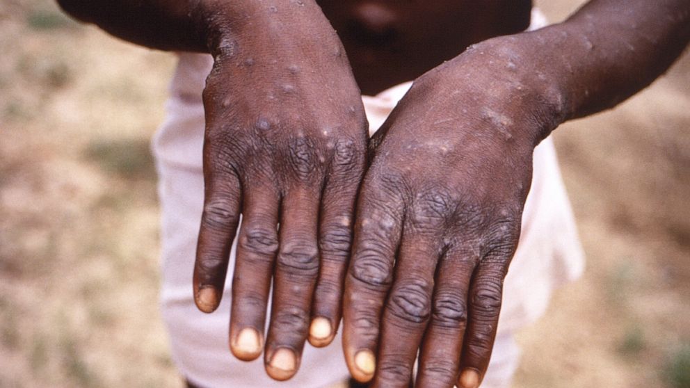 This 1997 image provided by the CDC during an investigation into an outbreak of monkeypox, which took place in the Democratic Republic of the Congo (DRC), formerly Zaire, and depicts the dorsal surfaces of the hands of a monkeypox case patient, who w