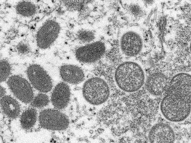 UK reports 104 more cases of monkeypox, mostly in men