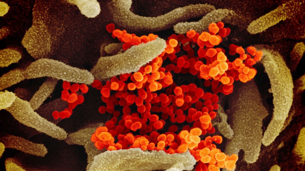 This image provided by The National Institute of Allergy and Infectious Diseases (NIAID). This scanning electron microscope image shows SARS-CoV-2 (orange)—also known as 2019-nCoV, the virus that causes COVID-19—isolated from a patient in the U.S., e