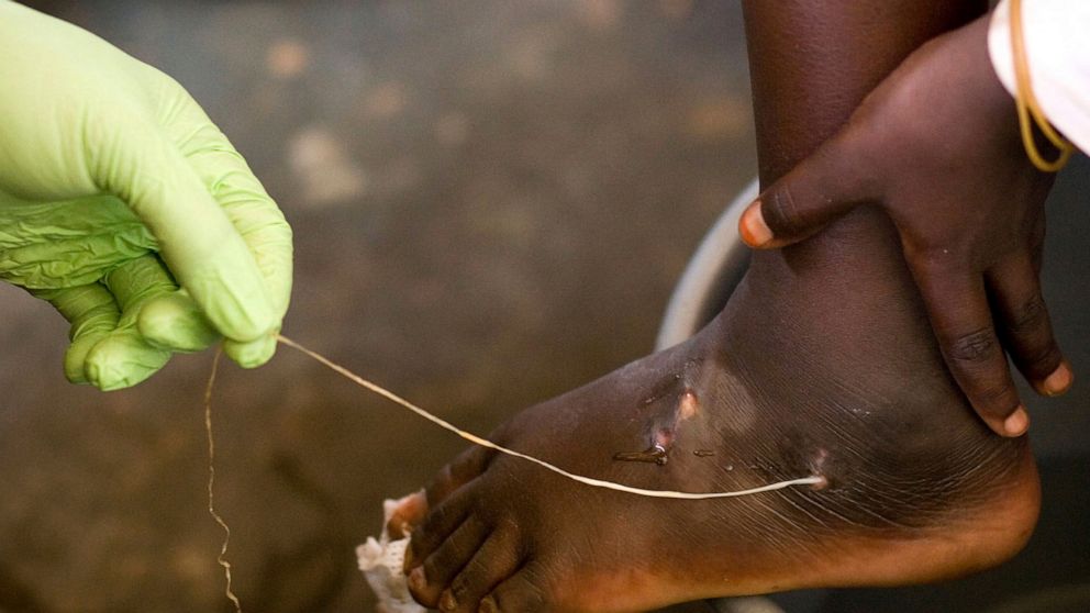 FILE - In this March 9, 2007, file photo, a Guinea worm is extracted by a health worker from a child's foot at a containment center in Savelugu, Ghana. The number of people infected with Guinea worm dropped to just over a dozen worldwide in 2021 as h
