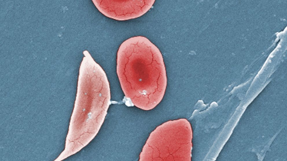FILE - This 2009 colorized microscope image made available by the Sickle Cell Foundation of Georgia via the Centers for Disease Control and Prevention shows a sickle cell, left, and normal red blood cells of a patient with sickle cell anemia. A study