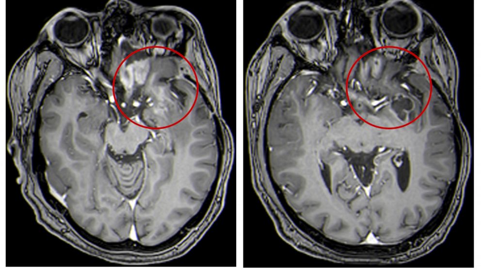 This combination of MRI images provided by the University of Alabama in April 2021 shows scans of a child with a brain tumor, before and after a treatment that involves using viruses to spur an immune system response to the cancerous cells. Lighter-c
