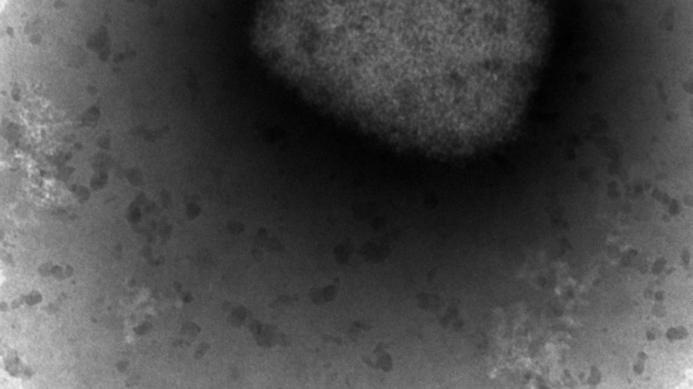 In this photo provided by the Unidad de Microscopía Electrónica del ISCIII in Madrid, on Thursday May 26, 2022, an electronic microscope image shows the monkeypox virus seen by a team from the Arbovirus Laboratory and the Genomics and Bioinformatics 