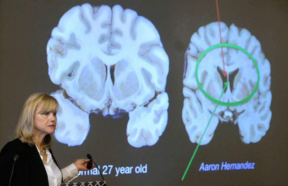 PHOTO: Ann McKee of Boston University's center for research into the degenerative brain disease chronic traumatic encephalopathy talks about damage to NFL football player Aaron Hernandez's brain, projected on a screen, in Boston, Nov. 9, 2017. 