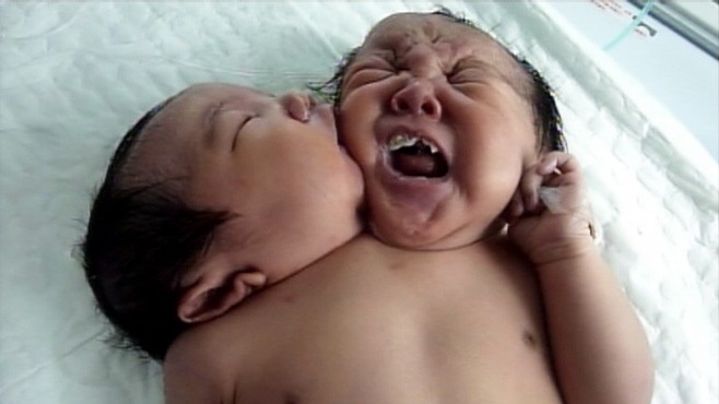 Chinese Conjoined Twins One Body Two Heads Video Abc News