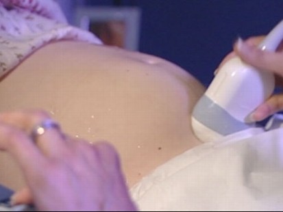 VIDEO: Is it safe to have a baby after beating breast cancer?