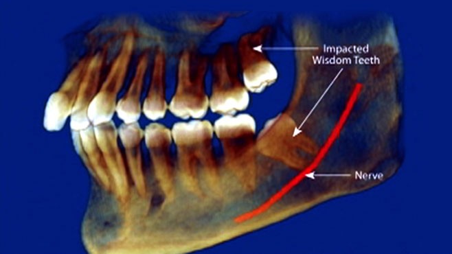 Examine This Report on Wisdom Teeth Pulled