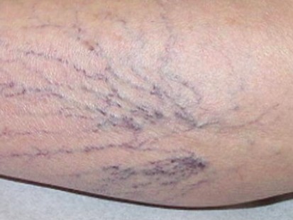 VIDEO: Get Rid of Varicose Veins
