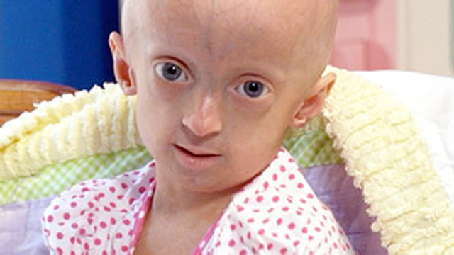 progeria kids