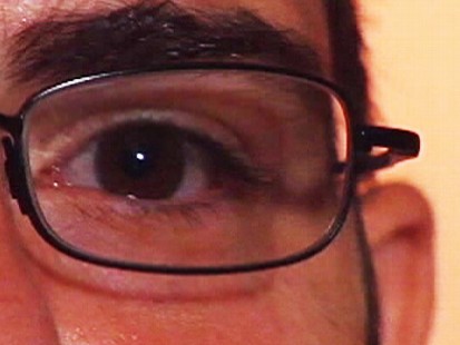 Video: Live maggot found inside teens eye.