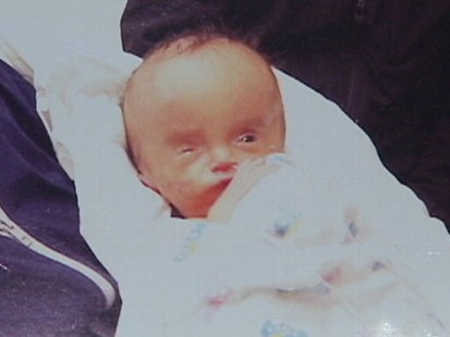 VIDEO: Parents of a 10-month-old boy raise awareness about his medical condition, hydrocephalus.