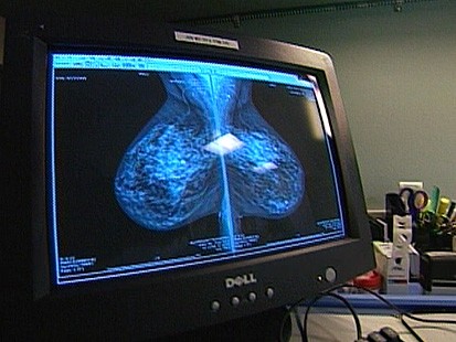 Breast Cancer Screening